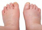 swollen-feet