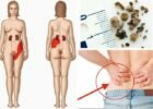 5-Signs-and-Symptoms-of-Kidney-Stones-You-Should-Know-About