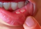 Natural-Home-Remedies-for-Mouth-Ulcers-e1464212627541