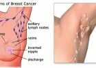 prevent-breast-cancer-by-doing-armpit-detox-with-this-simple-recipe-679x355